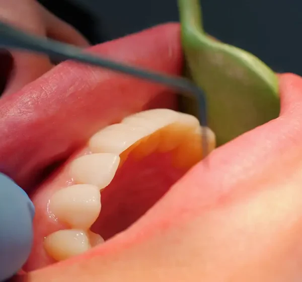 Periodontal disease treatment gum disease Periodontal disease treatment gum disease