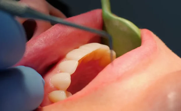 Periodontal disease treatment gum disease Periodontal disease treatment gum disease