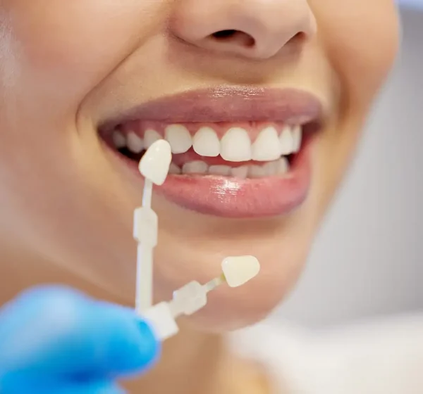 Porcelain Veneers Porcelain Veneers