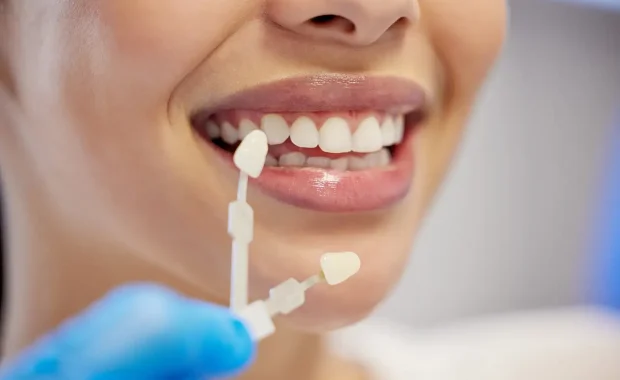 Porcelain Veneers Porcelain Veneers